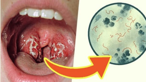 Factores predictivos son clave para la fiebre reumática en pacientes con dolor de garganta Factores predictivos son clave para la fiebre reumática en pacientes con dolor de garganta