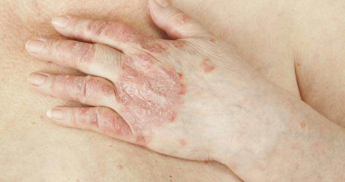 Estudio indica que pacientes podrían desarrollar artritis psoriásica mientras esperan medicamentos
