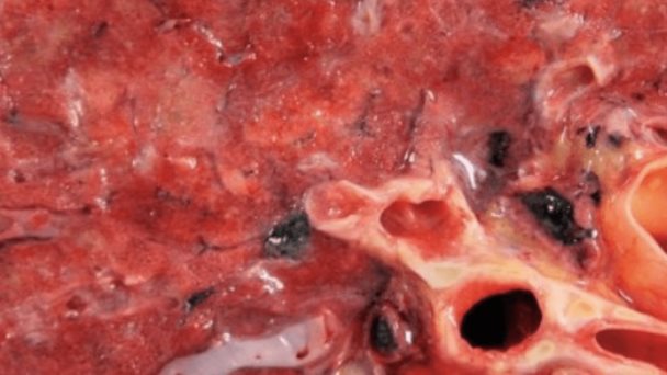 Autopsias pulmonares de pacientes con Covid-19 revelan pistas sobre su tratamiento Autopsias pulmonares de pacientes con Covid-19 revelan pistas sobre su tratamiento