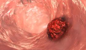 ¿Qué es la materia oscura de los alimentos y por qué puede ayudar en la prevención del Cáncer?