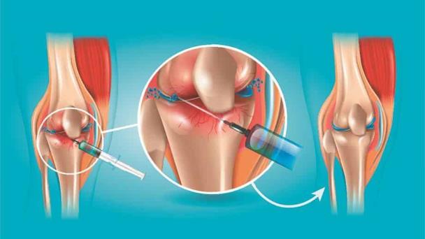 Las inyecciones de plasma rico en plaquetas no muestran ningún beneficio en la artrosis Las inyecciones de plasma rico en plaquetas no muestran ningún beneficio en la artrosis