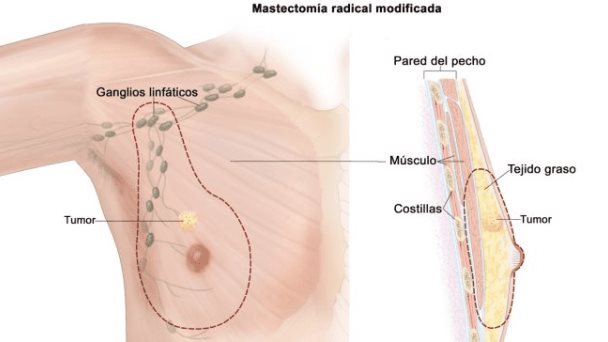 El trabajo en turnos nocturnos extremos puede estar relacionado con el cáncer de mama masculino El trabajo en turnos nocturnos extremos puede estar relacionado con el cáncer de mama masculino