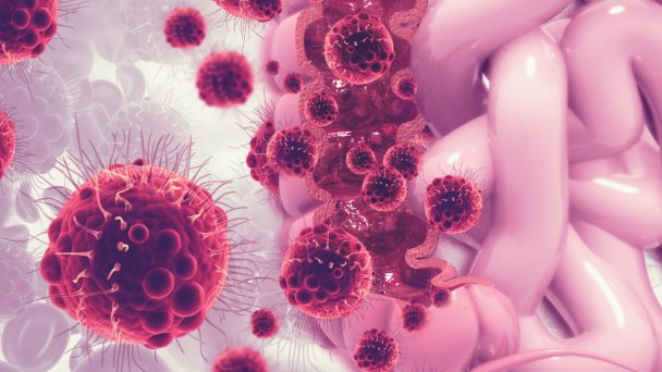 Detección y diagnóstico del cáncer colorrectal: Inteligencia artificial al servicio de la medicina Detección y diagnóstico del cáncer colorrectal: Inteligencia artificial al servicio de la medicina