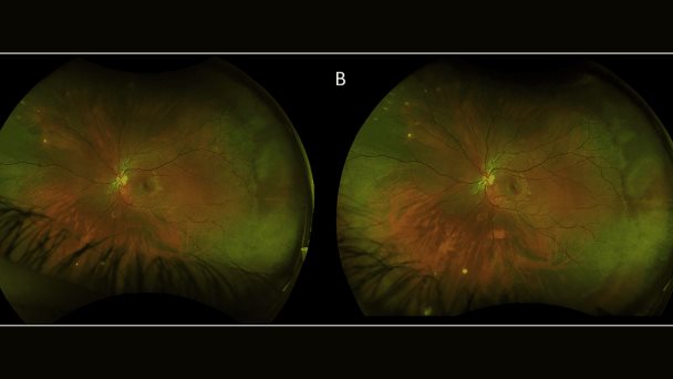 Reportan caso de coriorretinitis unilateral y ceguera parcial en paciente infectado por el virus Nilo