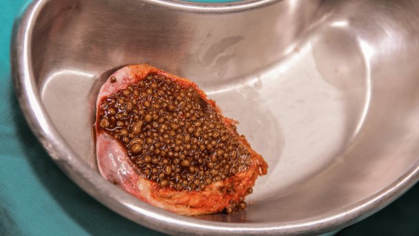América Latina entre los países con mayor incidencia de cáncer de la vesícula biliar América Latina entre los países con mayor incidencia de cáncer de la vesícula biliar