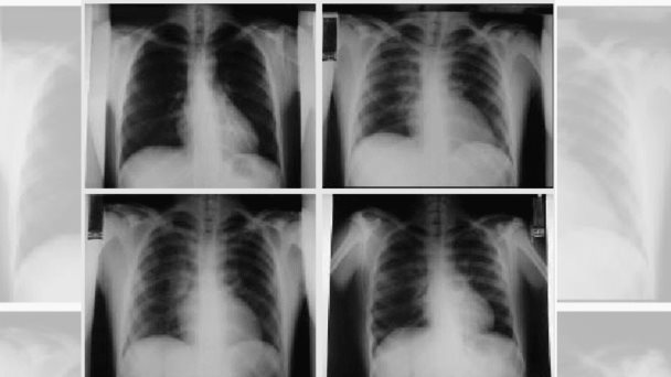 Demuestran beneficio de nitroglicerina en pacientes con edema pulmonar cardiogénico y fallo respiratorio Demuestran beneficio de nitroglicerina en pacientes con edema pulmonar cardiogénico y fallo respiratorio