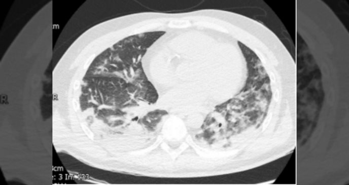 Registran accidente cerebrovascular fatal por enfermedad grave de COVID-19 en paciente joven