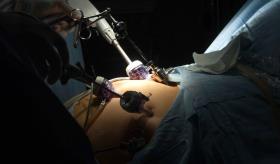 La cirugía bariátrica es el mejor tratamiento para la esteatosis hepática, según estudio