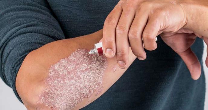 Nueva crema experimental mejora la psoriasis en placa, pero puede provocar efectos secundarios locales