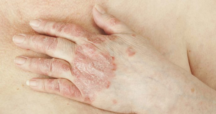 Revisión sistemática de literatura sostiene beneficio de biológicos para raro tipo de psoriasis