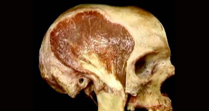 El grosor del músculo temporal predice la supervivencia del linfoma del Sistema Nervioso Central