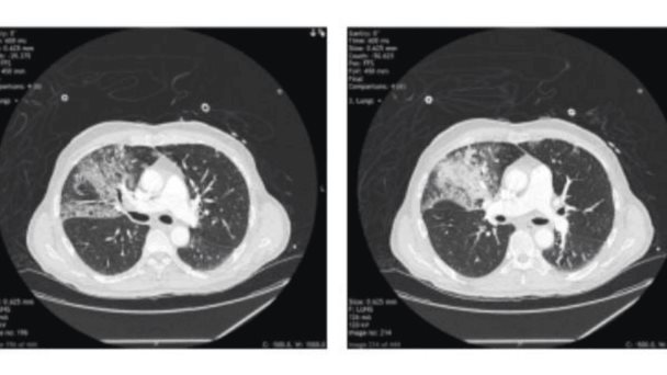 Se registra neumotórax espontáneo a tensión como complicación del COVID-19