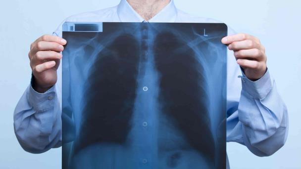 Umbrales de dímero D descartan tromboembolia pulmonar, según estudio Umbrales de dímero D descartan tromboembolia pulmonar, según estudio