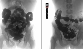 Colitis isquémica detrás de una EII