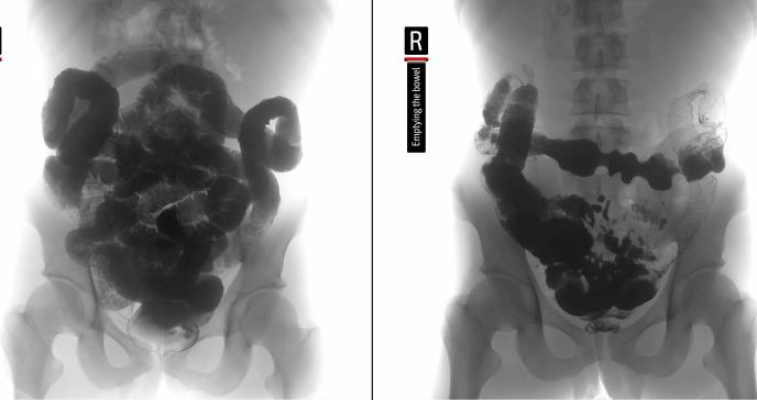 Importancia de los estilos de vida en los pacientes con Colitis Ulcerativa