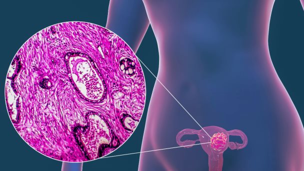 Cómo se inicia el cáncer de ovario en las mujeres con más riesgo Cómo se inicia el cáncer de ovario en las mujeres con más riesgo