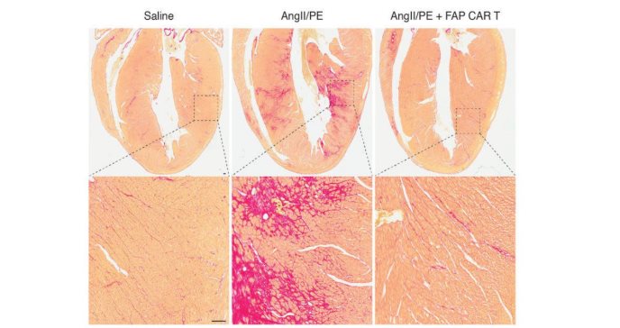 Investigación indica que la inmunoterapia podría ser utilizada para tratar la insuficiencia cardiaca