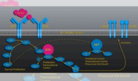 Variante de Guillain-Barré se presenta en medio de una leucemia linfocítica y síndrome paraneoplásico