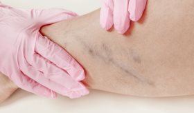 La nutrición influye sobre el desarrollo de la trombosis venosas profundas, recalca cardiólogo