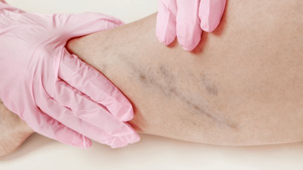 La nutrición influye sobre el desarrollo de la trombosis venosas profundas, recalca cardiólogo La nutrición influye sobre el desarrollo de la trombosis venosas profundas, recalca cardiólogo