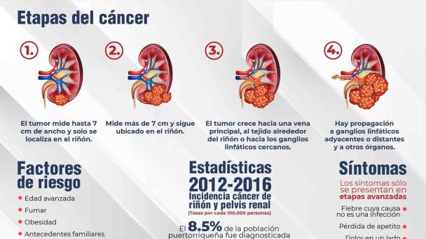 Infografía Cáncer de Riñón Infografía Cáncer de Riñón