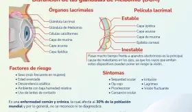 S&iacute;ndrome del Ojo Seco - Infograf&iacute;a