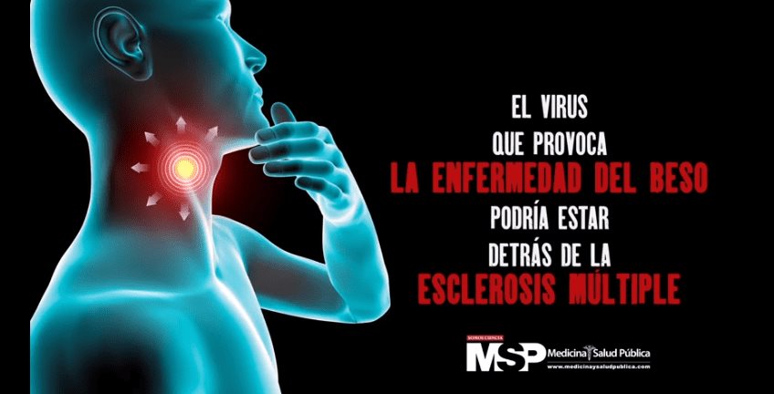 Virus de la enfermedad del beso puede ser la causa principal de la Esclerosis Múltiple