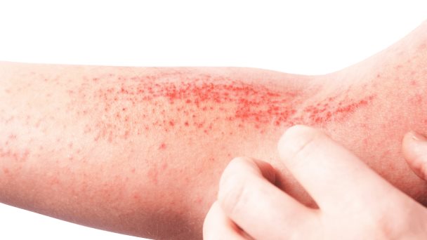La dermatitis atópica se asocia a un mayor riesgo de enfermedades autoinmunes La dermatitis atópica se asocia a un mayor riesgo de enfermedades autoinmunes
