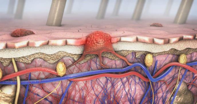 Identifican mecanismo de crecimiento del cáncer de piel