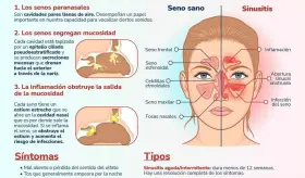 Sinusitis - Infografía