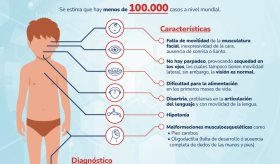 Síndrome de Moebius - Infografía
