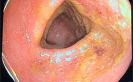 Two-Year-Old Hispanic Female With Acute Onset Painless Hematochezia