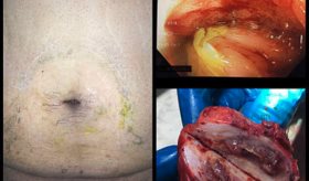 Severe Ulcerative Colitis-Like Pattern of Segmental Colitis With Diverticulosis