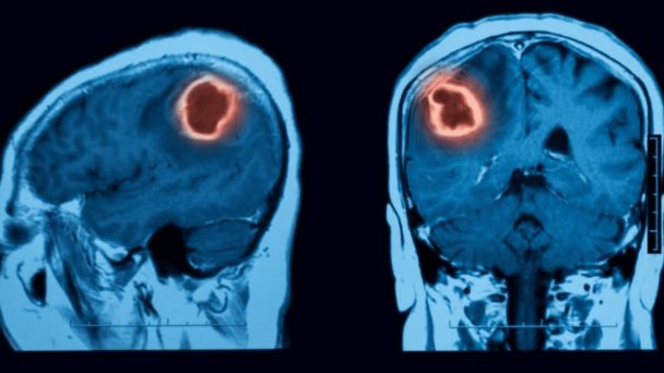 Los tumores cerebrales tienen una tasa de mortalidad más alta en hombres que en mujeres Los tumores cerebrales tienen una tasa de mortalidad más alta en hombres que en mujeres