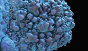 Linfoma malt gástrico con gammapatía biclonal y afectación de la médula ósea que simula mieloma múltiple