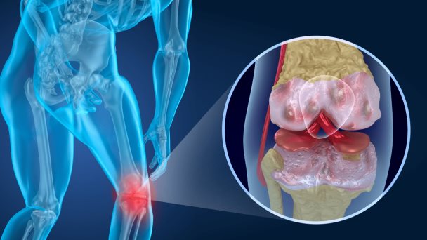 Subir de peso puede empeorar los síntomas óseos en pacientes con artrosis de rodilla. Subir de peso puede empeorar los síntomas óseos en pacientes con artrosis de rodilla.
