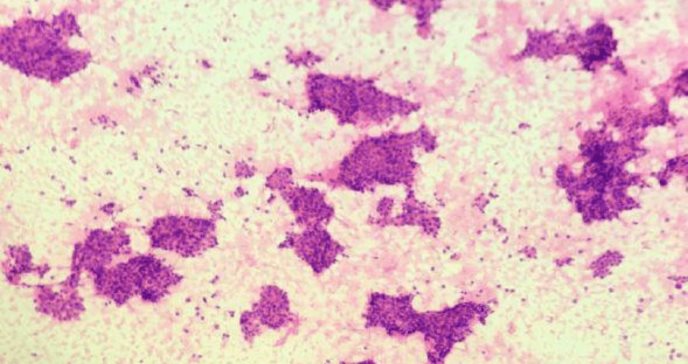 Tumor metastásico neuroendocrino es hallado en el estómago de una paciente