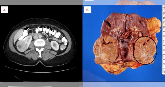 Raro caso de oncocitoma y angiomiolipoma renal sincrónico en paciente de 75 años