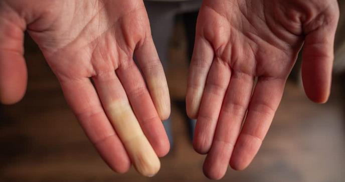 ¿Suele tener las manos o pies fríos y le cambian de color? Conozca el Fenómeno de Raynaud