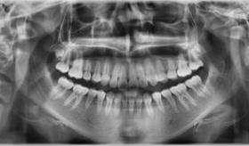 El bruxismo puede provocar problemas también en la articulación temporomandibular