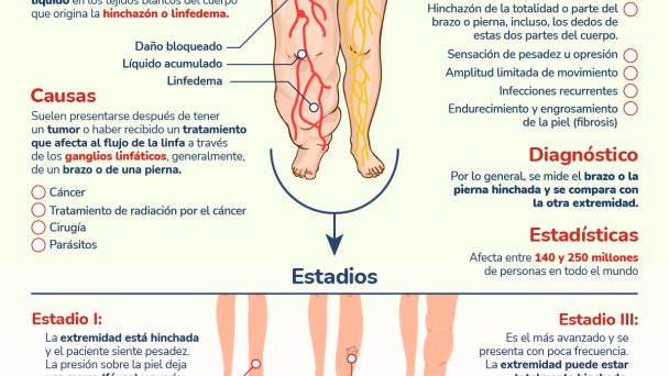 Linfedema - Infografía Linfedema - Infografía