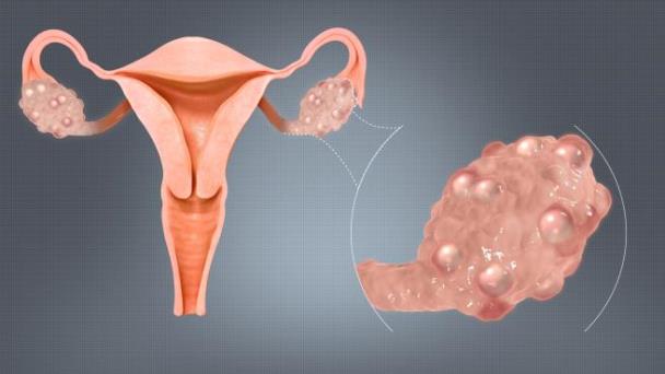 Dr. Serrano: La obesidad es factor determinante para el síndrome de ovario poliquístico