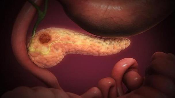 Estudio: Medicamentos para presión arterial prolongarían vida de pacientes con cáncer de páncreas Estudio: Medicamentos para presión arterial prolongarían vida de pacientes con cáncer de páncreas