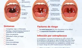 Amigdalitis - Infografía