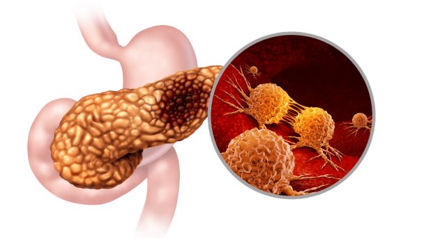 Quimiorradioterapia antes de la cirugía aumentaría la supervivencia por cáncer de páncreas, según estudio Quimiorradioterapia antes de la cirugía aumentaría la supervivencia por cáncer de páncreas, según estudio