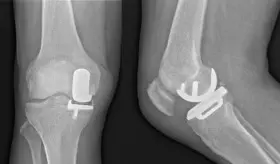 Diferencias genéticas ayudan a explicar por qué la artrosis de rodilla afecta más a las mujeres