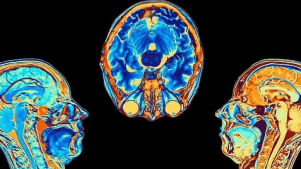 Estudio muestra cómo cambia el cerebro tras una infección por coronavirus, aunque esta sea leve Estudio muestra cómo cambia el cerebro tras una infección por coronavirus, aunque esta sea leve