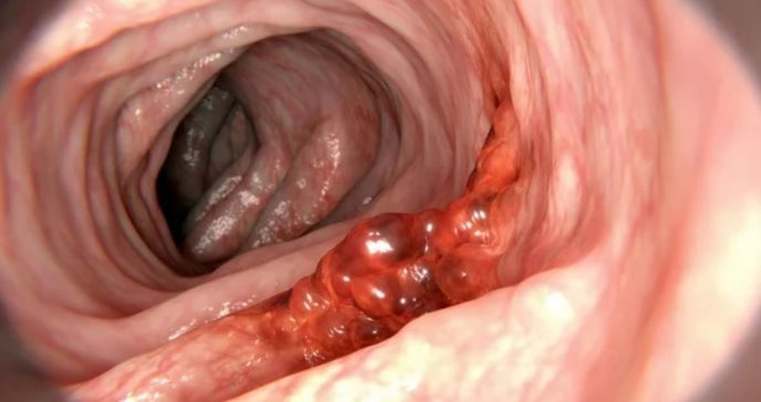 Revelan nuevas guías para la práctica clínica en la detección no invasiva del cáncer colorrectal