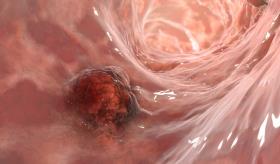 El exceso de peso a lo largo de la vida aumenta el riesgo de cáncer colorrectal