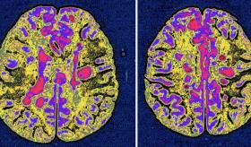 Investigación sobre esclerosis múltiple: nuevo método para controlar la eficacia del tratamiento